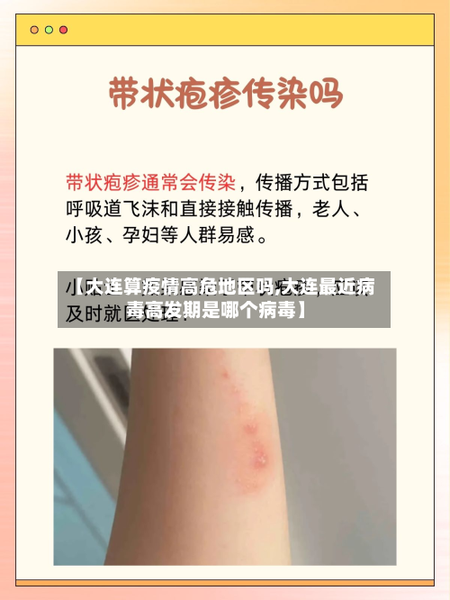 【大连算疫情高危地区吗,大连最近病毒高发期是哪个病毒】-第2张图片